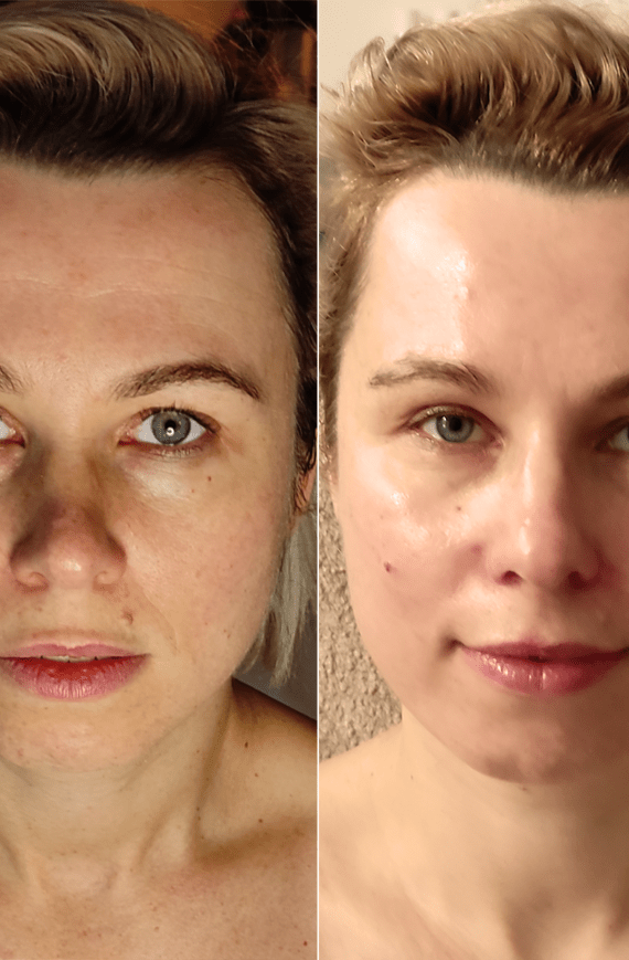 facemodeling efekty zabiegu w gabinecie Anna Hordyńska