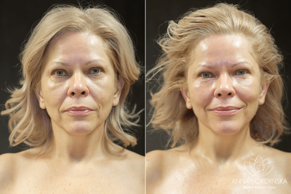 estetyczna rehabilitacja twarzy - beata zarembianka po zabiegu w gabinecie anna hordyńska